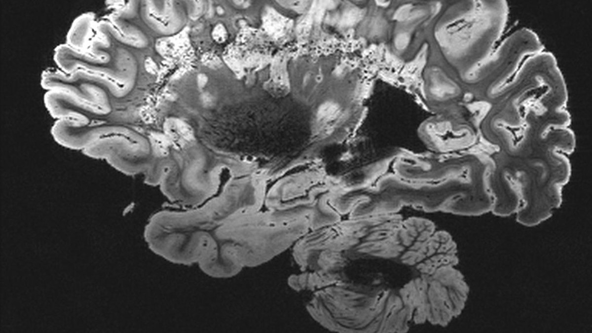 Sagittal brain section showing the hypothalamus, home of the orexin neurons targeted by orexin receptor agonists — Panacea Bio Chem record, Bogdan Dicoias
